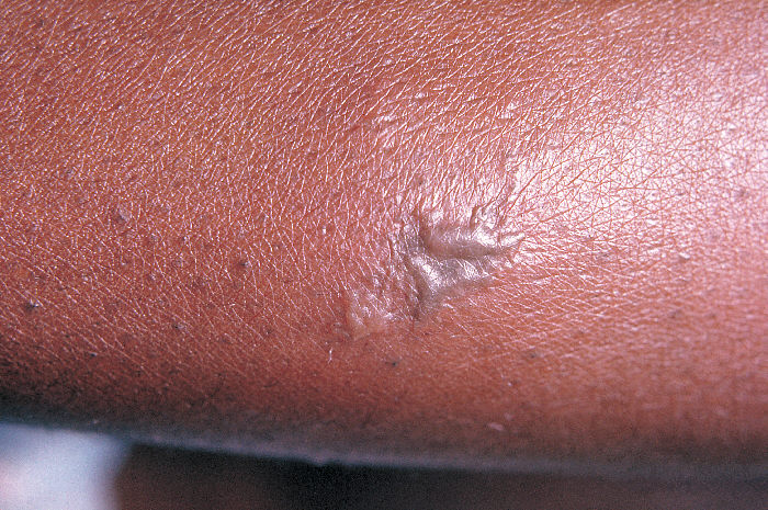 Lesión gonocócica en la piel