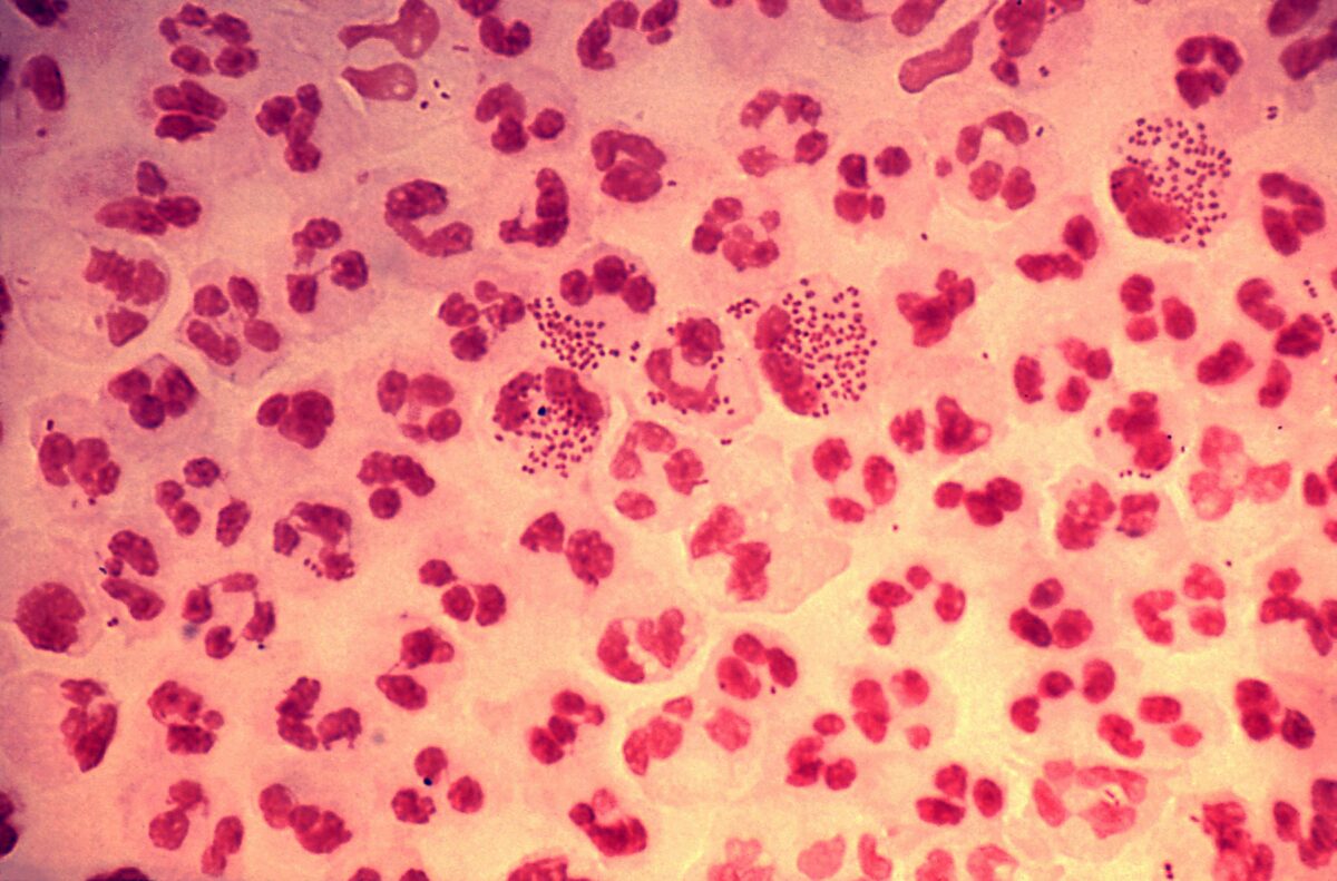 Histopathology in an acute case of gonococcal urethritis using g