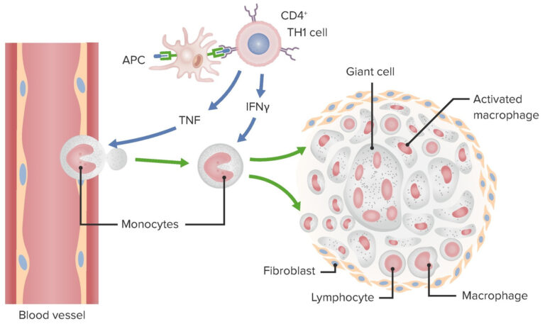 Type IV Hypersensitivity Reaction | Concise Medical Knowledge