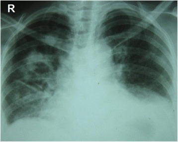 Granulomatosis chest radiography