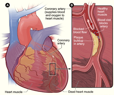 Graphic myocardial infarction