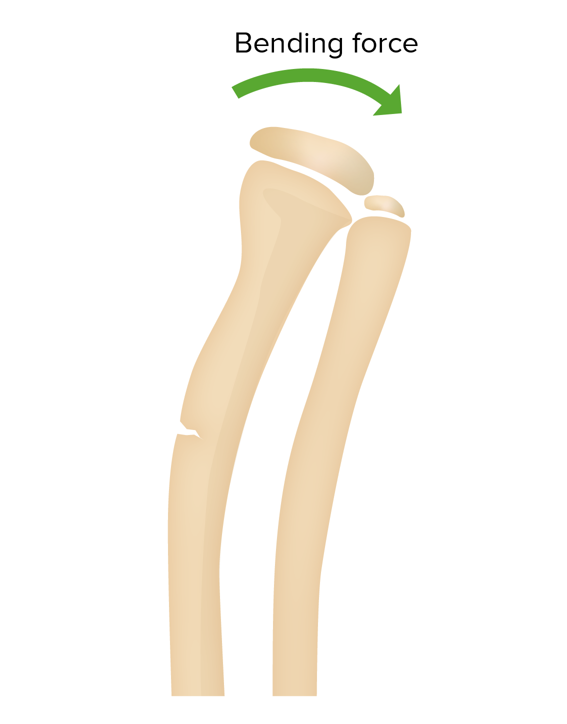 greenstick fracture x ray