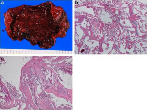 Gross and histological findings of hepatic hemangioma
