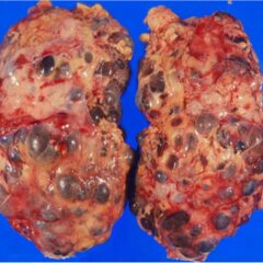 Gross pathology from nephrectomy in a patient with autosomal dominant polycystic kidney disease