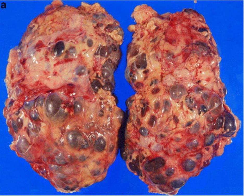 Gross pathology from nephrectomy in a patient with autosomal dominant polycystic kidney disease