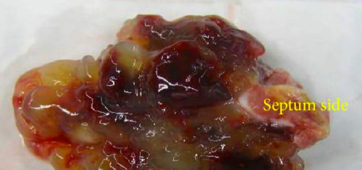 Gross pathology of excised left atrial myxoma