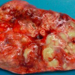 Gross specimen of resected lung from a patient with cystic fibrosis
