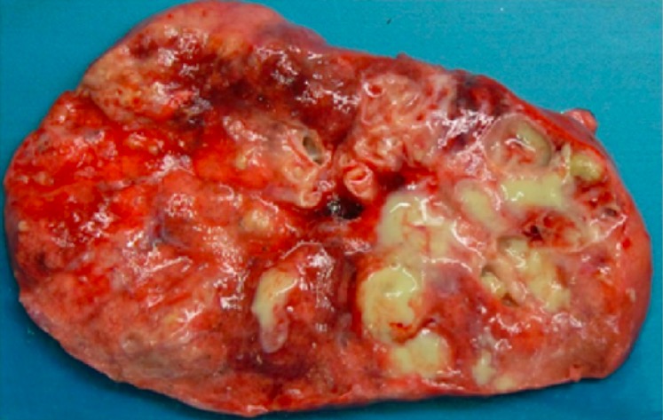 Gross specimen of resected lung from a patient with cystic fibrosis