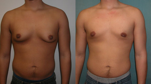 IS GYNECOMASTIA HEREDITARY? DOES IT RUN IN THE FAMILY ?