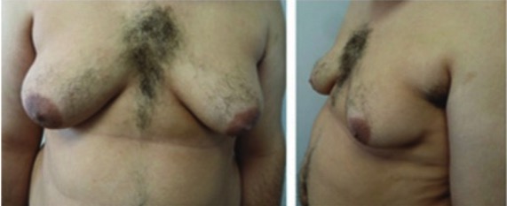 klinefelter syndrome in female