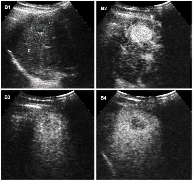 Hepatocellular carcinoma on ultrasound