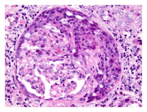 H&e stain showing crescentic glomerulonephritis in goodpasture syndrome