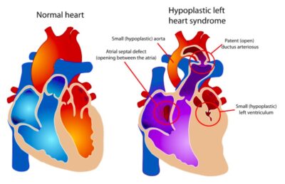 Hypoplastic Left Heart Syndrome (HLHS) | Concise Medical Knowledge