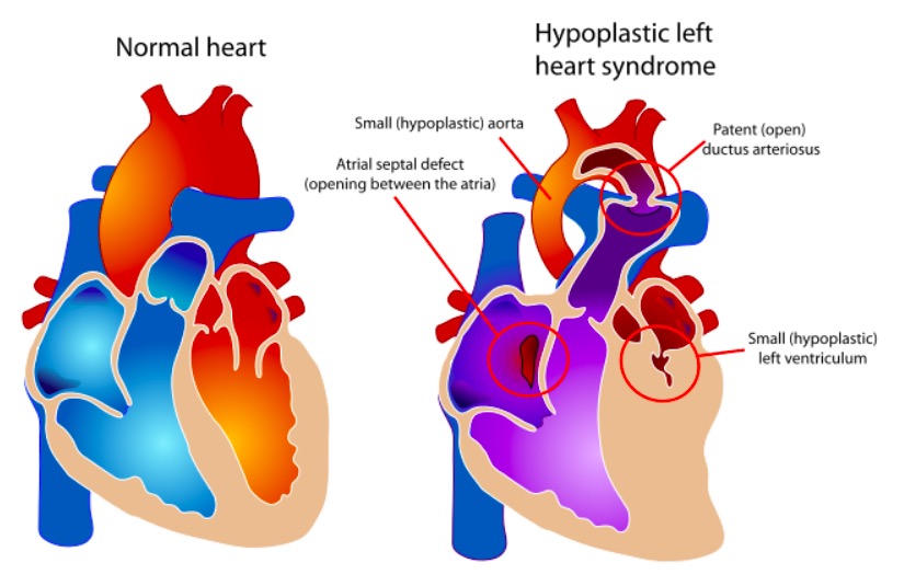 Hypoplastic Left Heart Syndrome (HLHS) | Concise Medical Knowledge