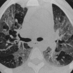 HRCT in bronchiolitis obliterans