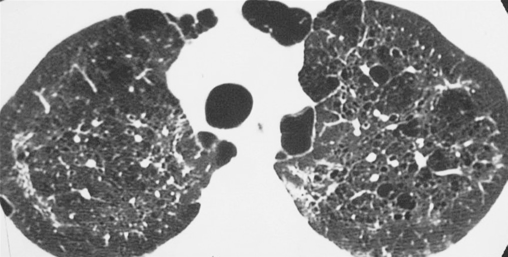 High-resolution computed tomography of multiple lung cysts pneumocystis pneumonia