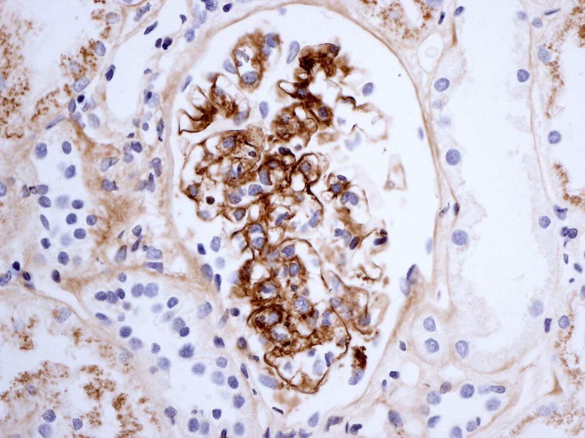 Biopsia renal phs que muestra inmunotinción para iga