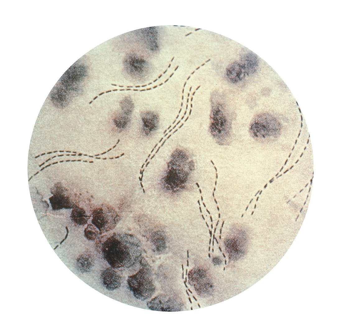 La bacteria haemophilus ducreyi