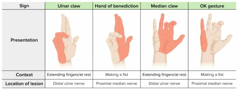 Peripheral Nerve Injuries in the Upper Extremity | Concise Medical ...