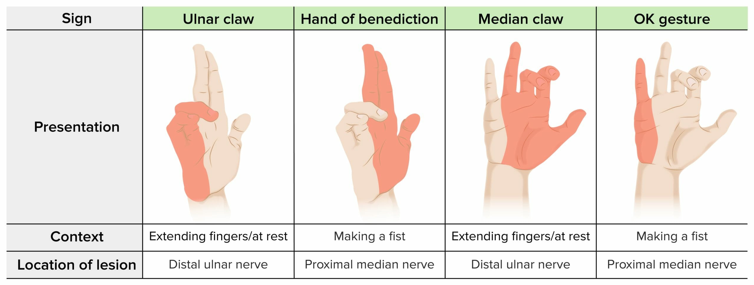 Upper Limb Nerve Lesions (Part 3 – The Median Nerve) - Medical Exam Prep