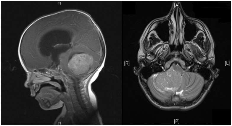 Ressonância magnética craniana com um meduloblastoma cerebelar