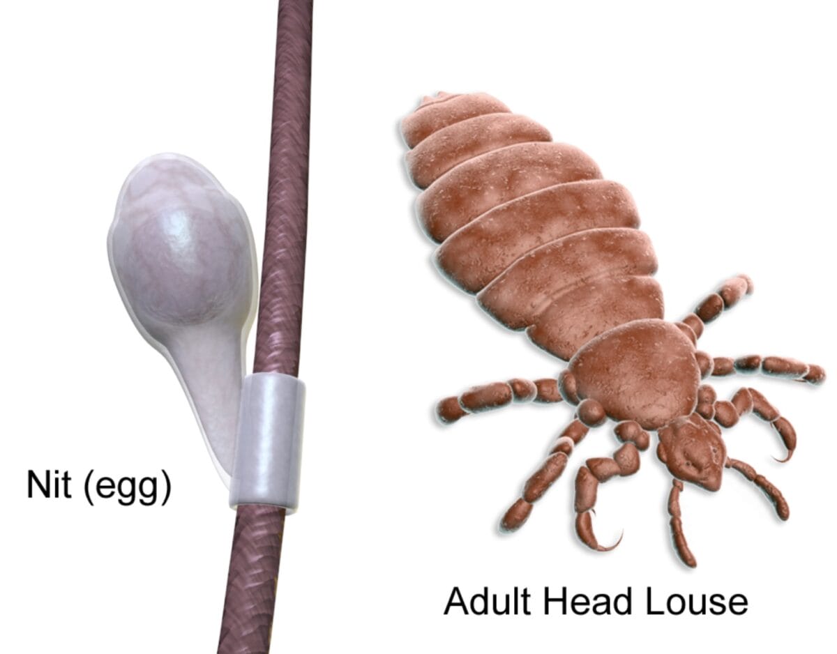 Head louse and nit