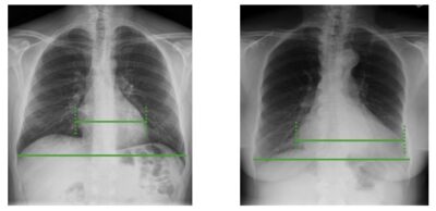 Imaging of the Lungs and Pleura | Concise Medical Knowledge