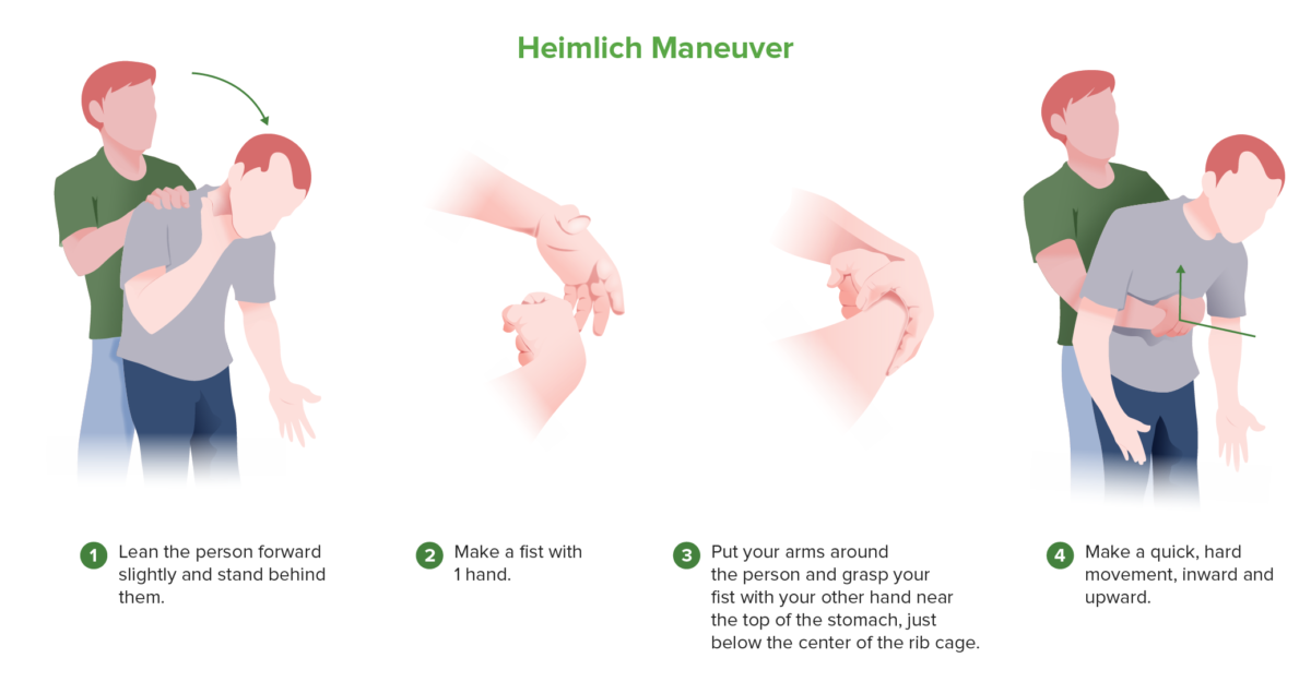 Heimlich maneuver