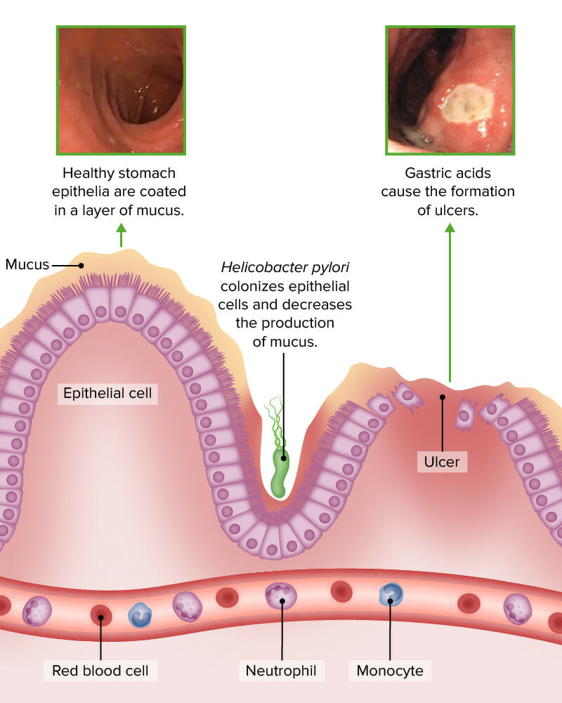 Helicobacter infection decreases mucus production and increases risk for ulcer formation 2