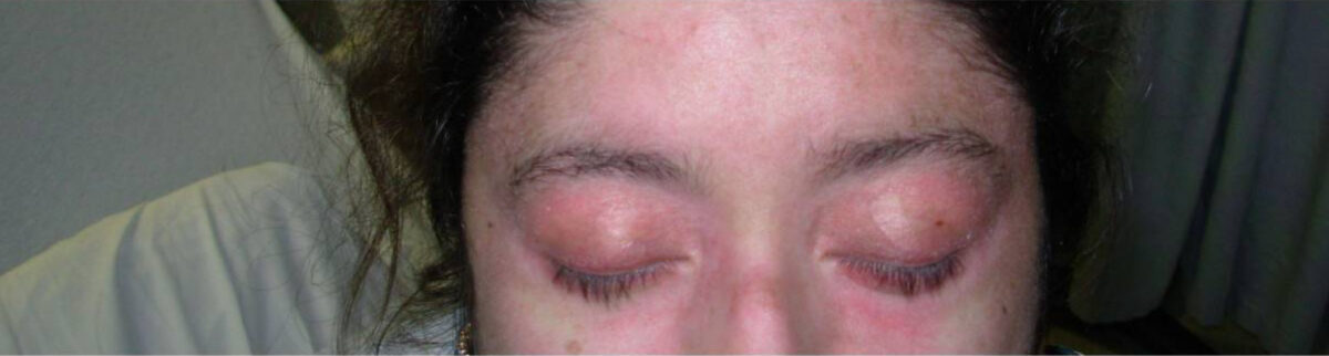 Heliotrope rash in dermatomyositis