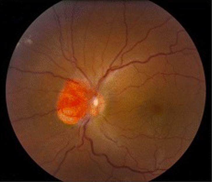Hemangioblastoma involving the optic nerve