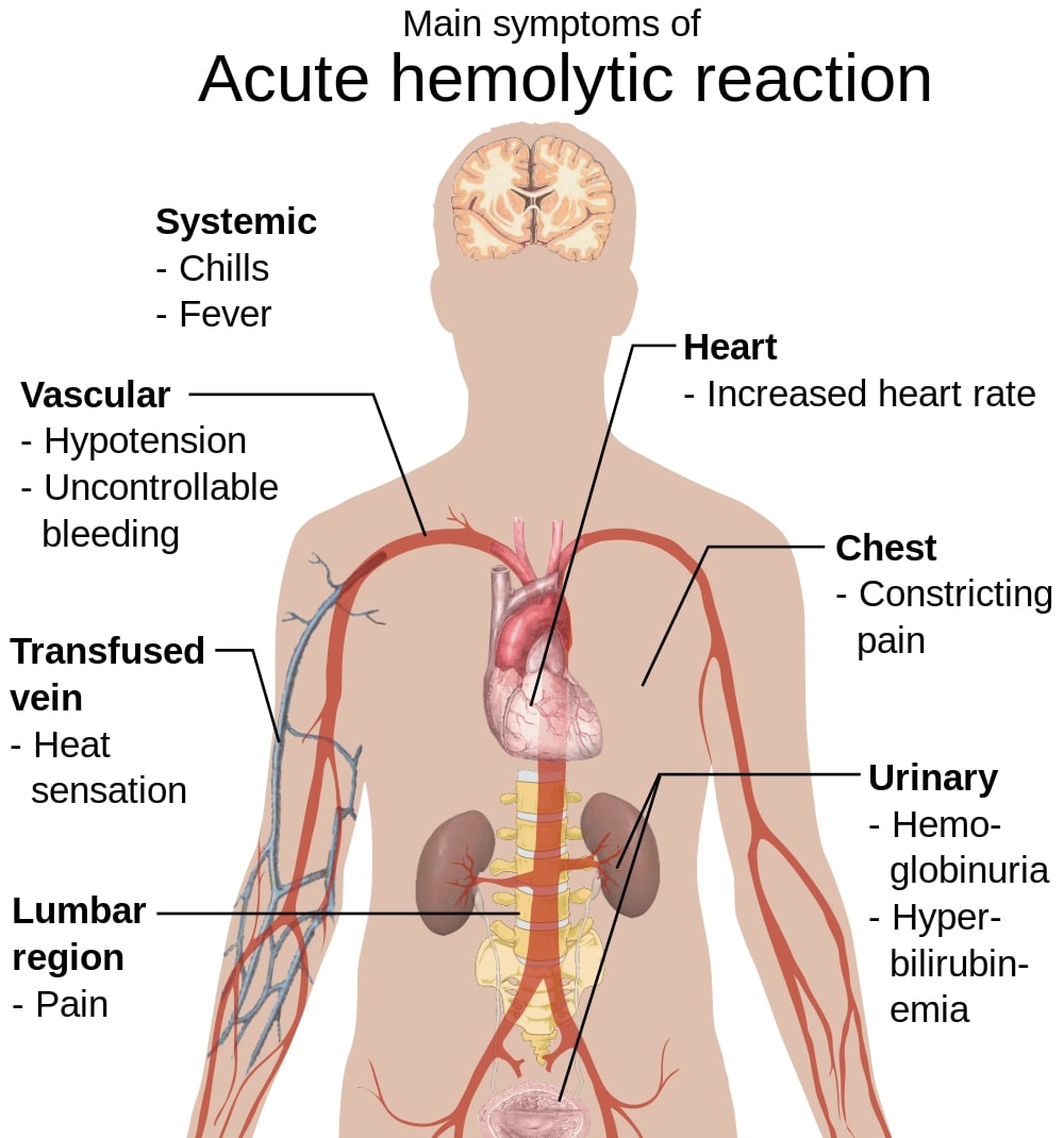 Sintomas de reação hemolítica