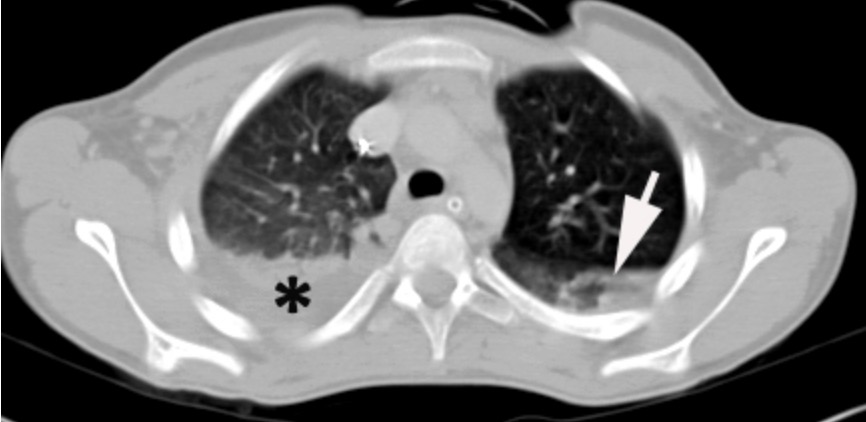 hemothorax lung sounds