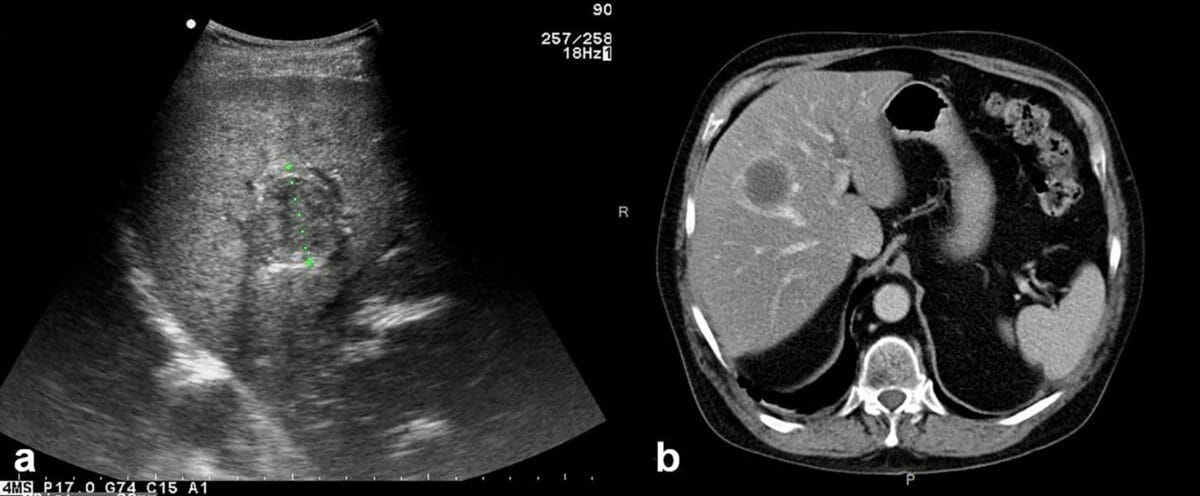 Hepatic alveolar echinococcosis imaging