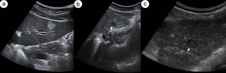 Liver Hemangioma Ultrasound Images