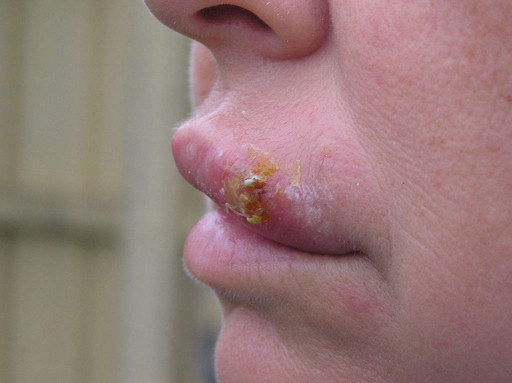 Herpes cold sore