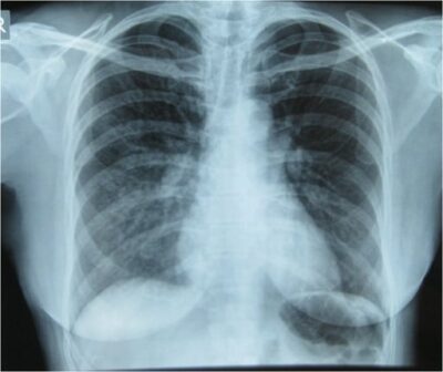 High-altitude pulmonary edema