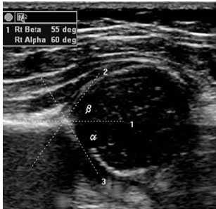 Normal infant hip ultrasound