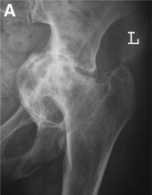 Hip issues in marfan syndrome