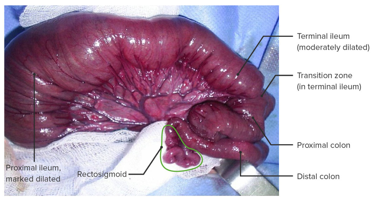 Hirschsprung disease with total colonic aganglionosis