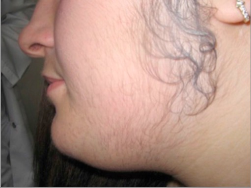 Pcos without hirsutism