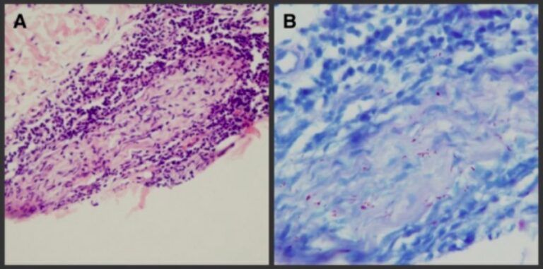 Leprosy | Concise Medical Knowledge