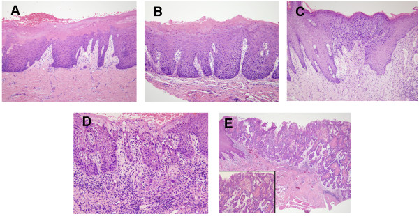 leukoplakia tongue histology