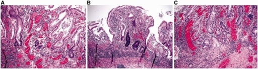 Histological evaluation in ulcerative colitis