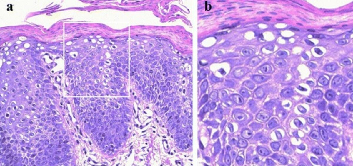 Histological findings in ichthyosis