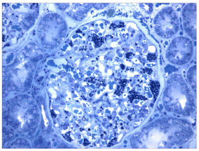 Histological slide from a kidney biopsy fabry disease