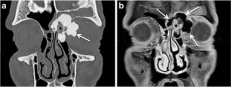 Benign Bone Tumors | Concise Medical Knowledge