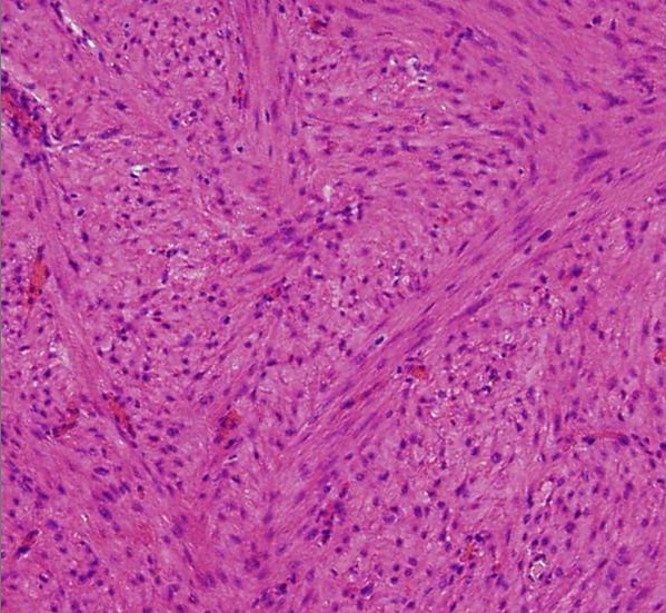 Uterine Leiomyoma And Leiomyosarcoma Concise Medical Knowledge