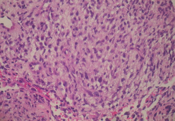 Histology of leiomyosarcoma