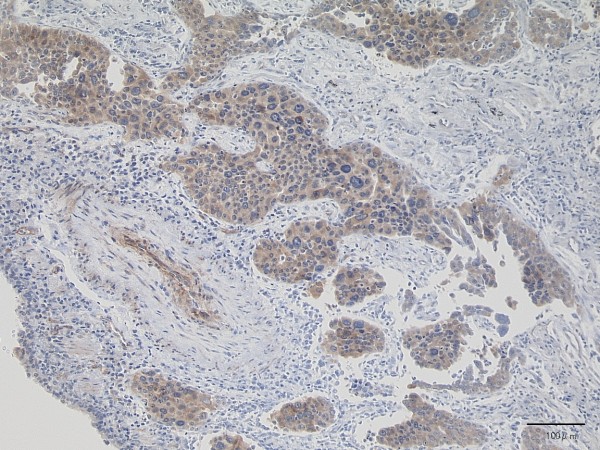 Histology of the specimen shows cancer cells in lambert-eaton myasthenic syndrome